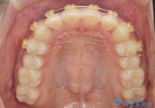 ワイヤー部分矯正を併用して治療期間を短縮 マウスピース矯正治療の治療中