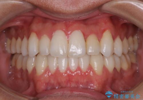 【非抜歯】八重歯を治す　マウスピース矯正の症例 治療後