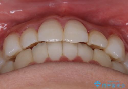 【非抜歯】八重歯を治す マウスピース矯正の治療後