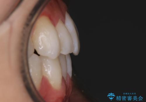 【非抜歯】八重歯を治す マウスピース矯正の治療後