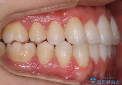 【非抜歯】八重歯を治す　マウスピース矯正の治療後