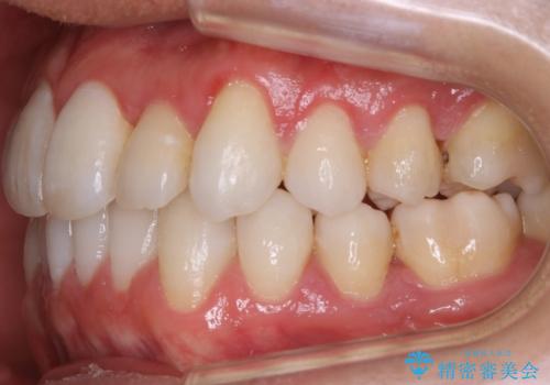 【非抜歯】八重歯を治す マウスピース矯正の治療後
