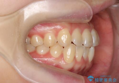 [ インビザライン ]前歯のガタつきを治したいの治療前