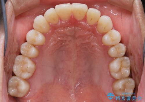 【非抜歯】八重歯を治す マウスピース矯正の治療後