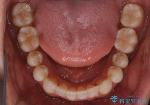 【非抜歯】八重歯を治す マウスピース矯正の治療後