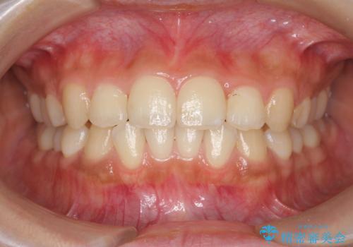 ワイヤー部分矯正を併用して治療期間を短縮 マウスピース矯正治療の治療中