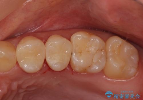 セラミックインレーによる治療の症例 治療後