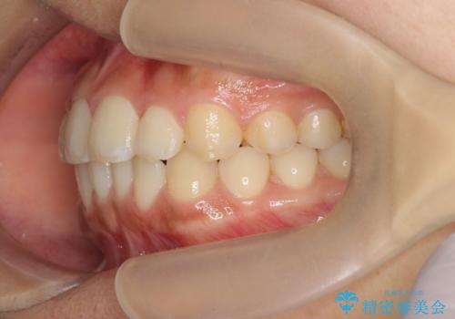 ワイヤー部分矯正を併用して治療期間を短縮 マウスピース矯正治療の治療中