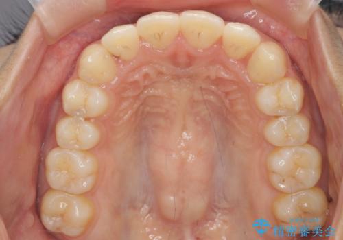 ワイヤー部分矯正を併用して治療期間を短縮 マウスピース矯正治療の治療中