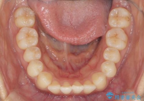 ワイヤー部分矯正を併用して治療期間を短縮 マウスピース矯正治療の治療中