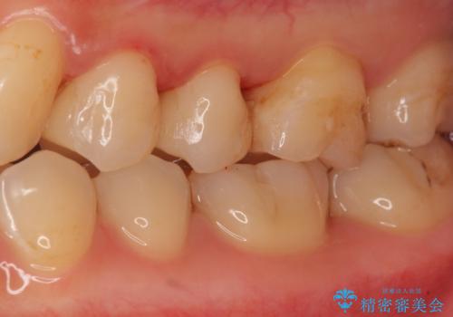 セラミックインレーによる治療の治療後