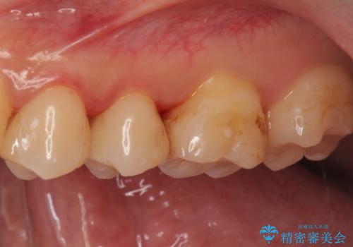 セラミックインレーによる治療の治療後