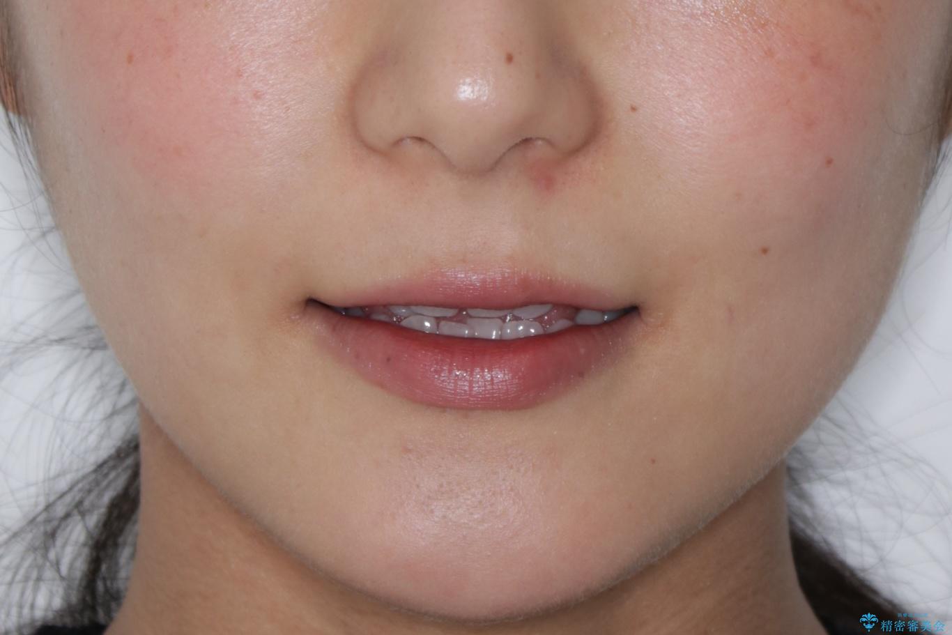 【非抜歯】左右の八重歯・前歯の反対咬合の改善 インビザラインの治療前(顔貌)