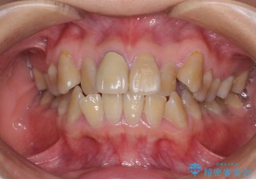 八重歯とクロスバイト　目立たないワイヤー装置での抜歯矯正の症例 治療前