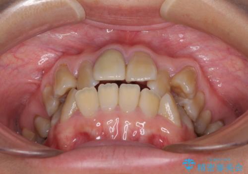 八重歯とクロスバイト 目立たないワイヤー装置での抜歯矯正の治療前