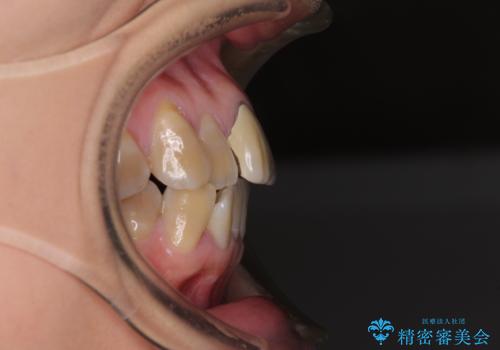 八重歯とクロスバイト 目立たないワイヤー装置での抜歯矯正の治療前