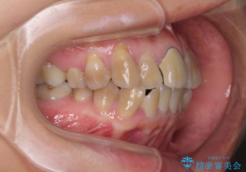 八重歯とクロスバイト　目立たないワイヤー装置での抜歯矯正の治療前