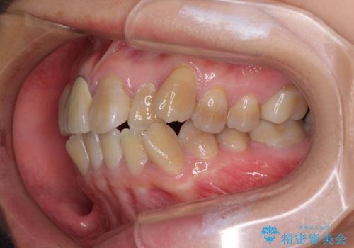 八重歯とクロスバイト 目立たないワイヤー装置での抜歯矯正の治療前