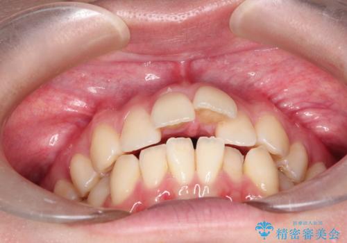 ワイヤーによる抜歯矯正でガタガタの改善の治療前
