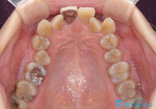 八重歯とクロスバイト 目立たないワイヤー装置での抜歯矯正の治療前