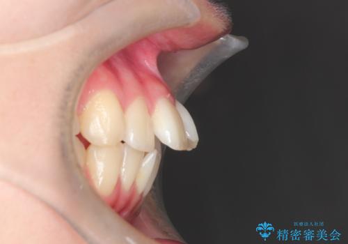 ワイヤーによる抜歯矯正でガタガタの改善の治療前