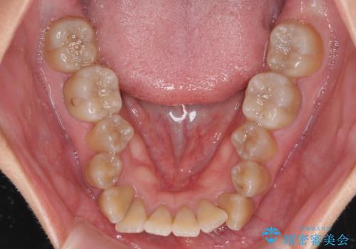 八重歯とクロスバイト　目立たないワイヤー装置での抜歯矯正の治療前