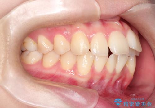 ワイヤーによる抜歯矯正でガタガタの改善の治療前