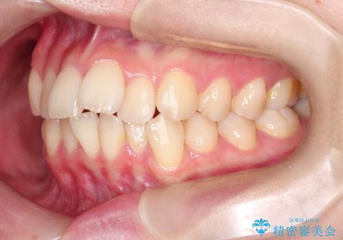 ワイヤーによる抜歯矯正でガタガタの改善の治療前
