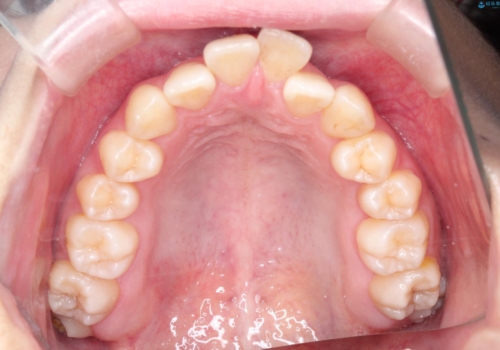ワイヤーによる抜歯矯正でガタガタの改善の治療前