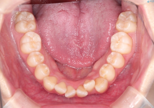 ワイヤーによる抜歯矯正でガタガタの改善の治療前