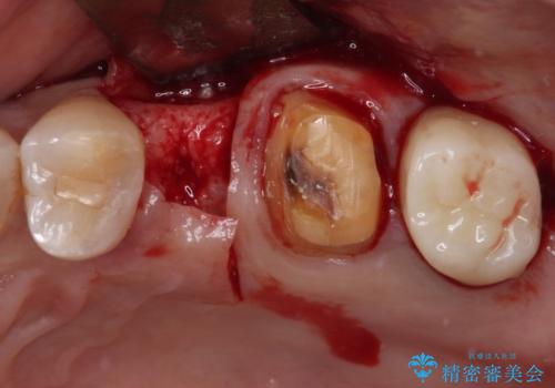 治療後に歯茎から出血 インプラントとオールセラミッククラウンの補綴治療の治療前