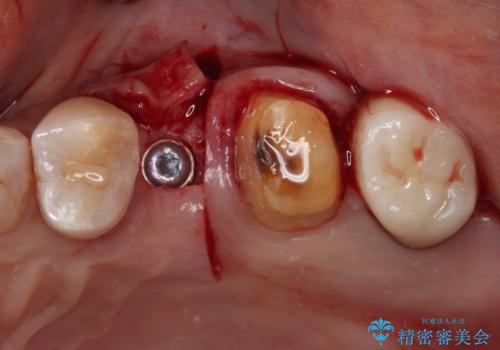 治療後に歯茎から出血 インプラントとオールセラミッククラウンの補綴治療の治療中