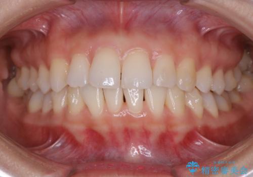 【非抜歯】前歯のガタつき マウスピースの部分矯正の治療中