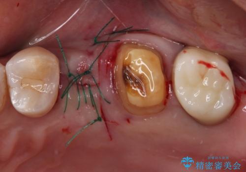 治療後に歯茎から出血 インプラントとオールセラミッククラウンの補綴治療の治療後