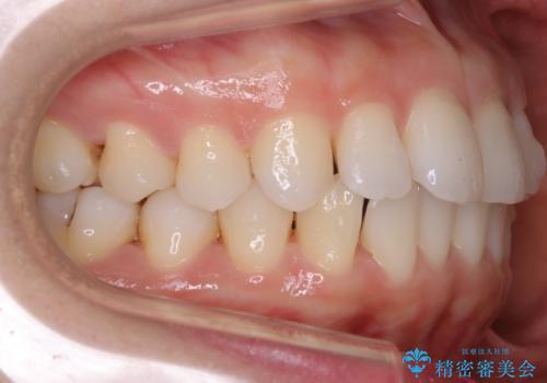 【非抜歯】前歯のガタつき マウスピースの部分矯正の治療中