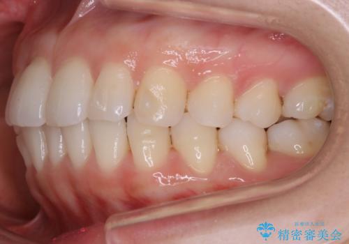 【非抜歯】前歯のガタつき マウスピースの部分矯正の治療中