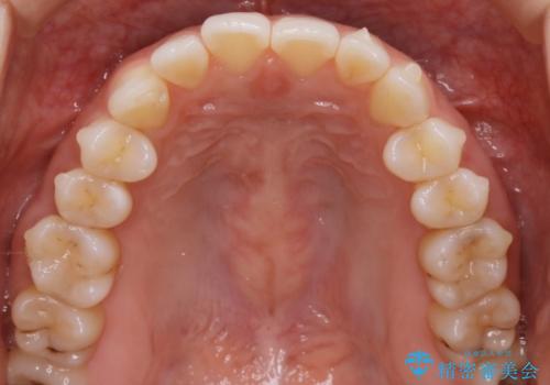 【非抜歯】前歯のガタつき　マウスピースの部分矯正の治療中