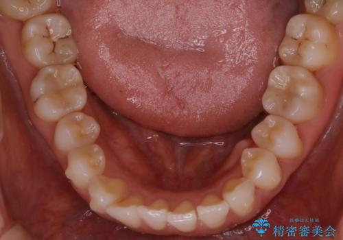 【非抜歯】前歯のガタつき　マウスピースの部分矯正の治療中