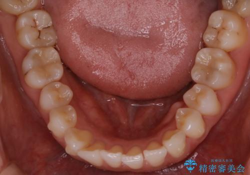 【非抜歯】前歯のガタつき マウスピースの部分矯正の治療中