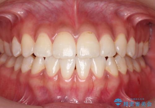 口元の印象が変わります。　引っ込んでいる前歯を出す治療の症例 治療後