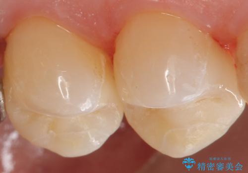 外から見える銀歯 セラミックでのやり替えの治療後