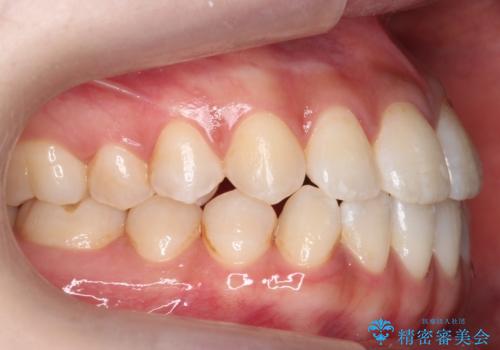 口元の印象が変わります。 引っ込んでいる前歯を出す治療の治療後