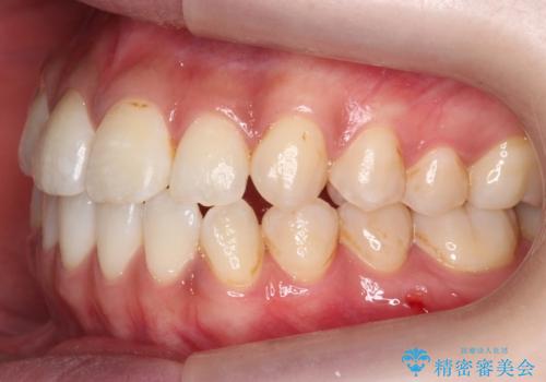 口元の印象が変わります。 引っ込んでいる前歯を出す治療の治療後