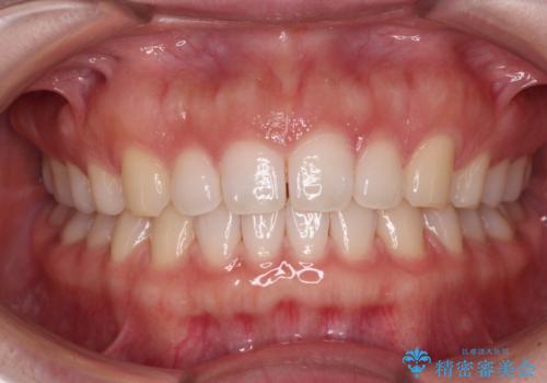 すきっ歯とオープンバイト　インビザライン・ライトで改善の治療中