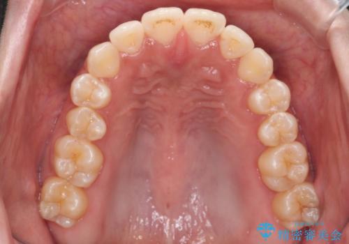 口元の印象が変わります。 引っ込んでいる前歯を出す治療の治療後
