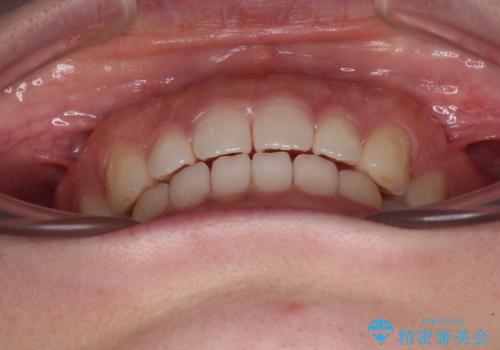 すきっ歯とオープンバイト インビザライン・ライトで改善の治療中