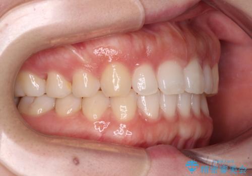 すきっ歯とオープンバイト インビザライン・ライトで改善の治療中