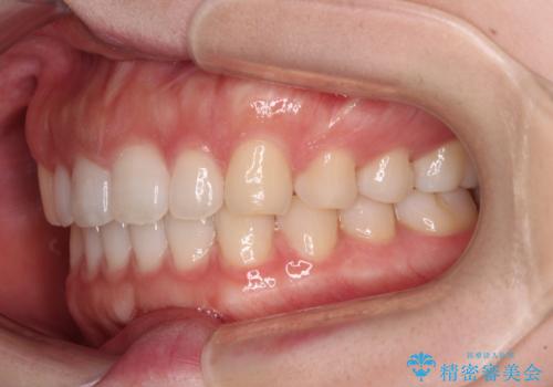 すきっ歯とオープンバイト インビザライン・ライトで改善の治療中