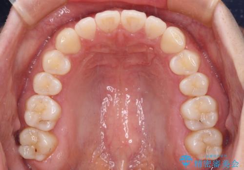 すきっ歯とオープンバイト インビザライン・ライトで改善の治療中