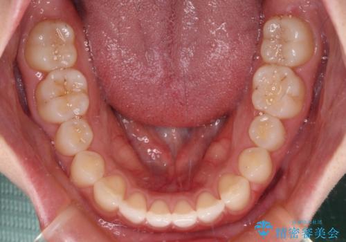 すきっ歯とオープンバイト インビザライン・ライトで改善の治療中